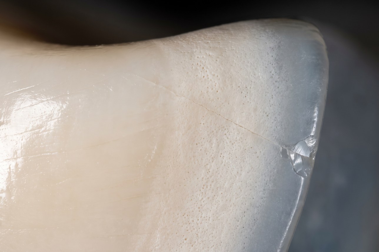 Tooth enamel erosion — glossy sound enamel meeting a chalky etched zone under macro
