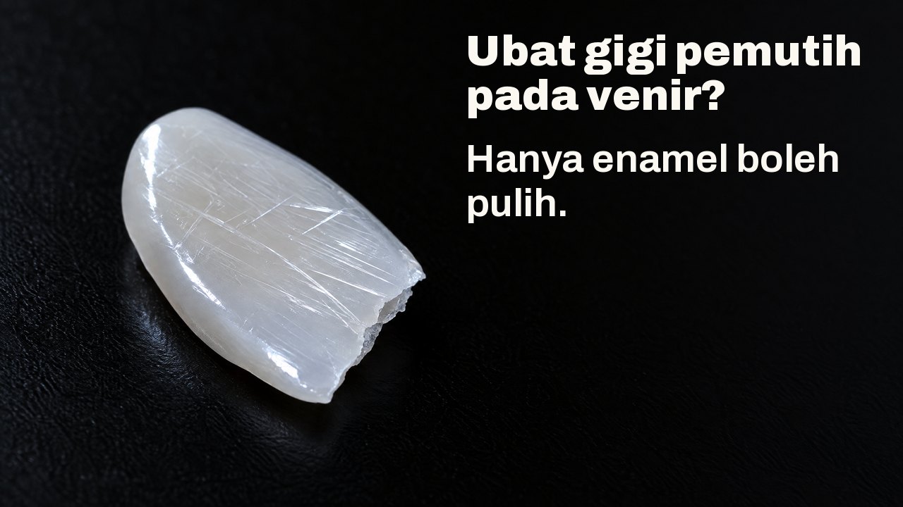 Ubat gigi pemutih pada venir? Hanya enamel boleh pulih. Dalam cahaya condong: serpihan porselin nipis berkilat seperti venir, permukaannya bergaris calar halus, di atas hitam.
