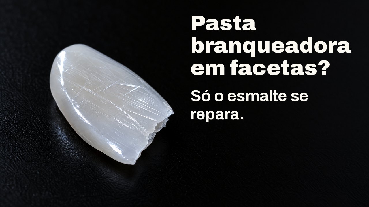 Pasta branqueadora em facetas? Só o esmalte se repara. Com luz rasante: um fino fragmento de porcelana brilhante, como uma faceta, riscado de arranhões finos, sobre preto.