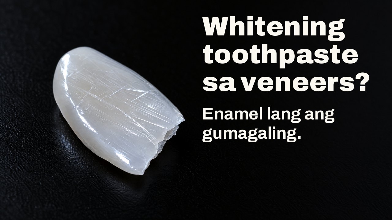 Whitening toothpaste sa veneers? Enamel lang ang gumagaling. Sa pahilis na liwanag: manipis na makintab na piraso ng porselana na parang veneer, may pinong gasgas, sa itim.